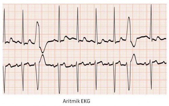 Aritmik_EKG.JPG