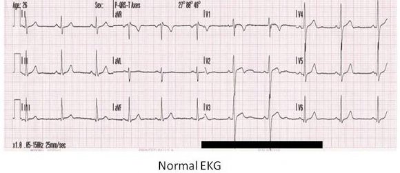 Normal_EKG.JPG
